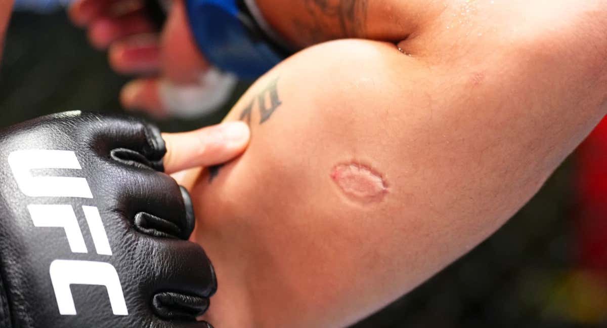 Lima muestra el mordisco que le ha dado Severino en pleno combate./Getty Images