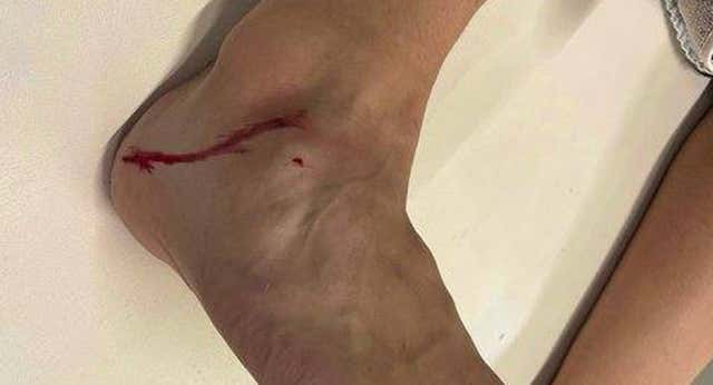 Ceballos enseña su tobillo ensangrentado: ‘Luego se quejan de Miranda…’