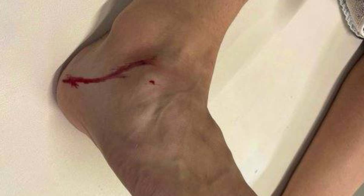 Dani Ceballos mostró en Twitter el estado de su tobillo tras la fea entrada de Acuña.