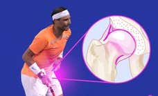 Qué es el lábrum y por qué es tan importante esa segunda operación a la que se ha sometido Nadal