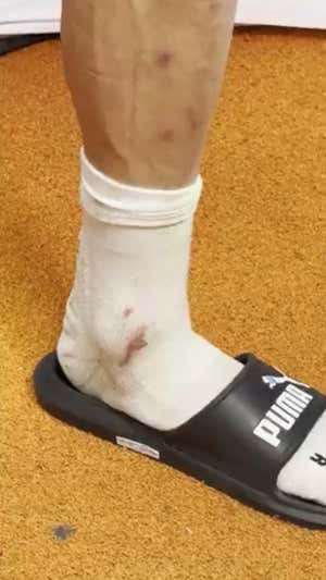 Así acabó el tobillo de Pepelu tras la roja a Navarro.  Valencia C.F