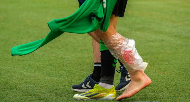 ¡Isco se fractura el peroné y dice adiós al sueño de la Eurocopa!
