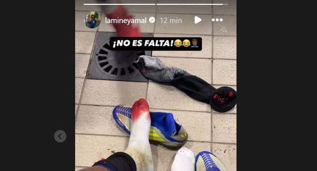 Lamine Yamal protesta por el arbitraje con un mensaje en Instagram con un pie ensangrentado: «¡No es falta!»